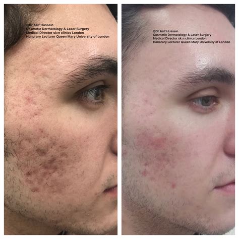 Laser Treatment For Acne Scars Before And After Pictures at Oscar ...