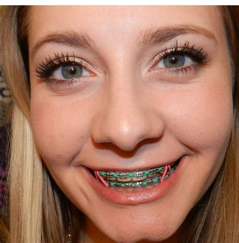 Is Green A Good Color For Braces - Kristal Lexus
