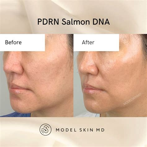 PDRN Salmon DNA Skin Booster Treatment - Vancouver's Aesthetic Cosmetic ...