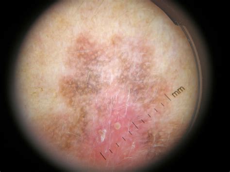 Squamous Cell Carcinoma In Situ | School of Medicine