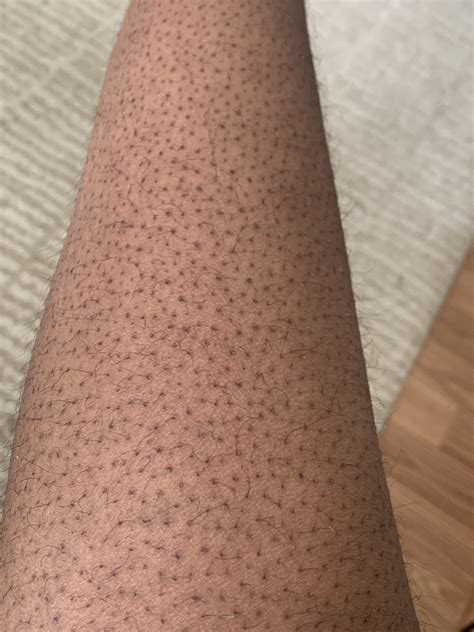 Clogged Pores On Legs
