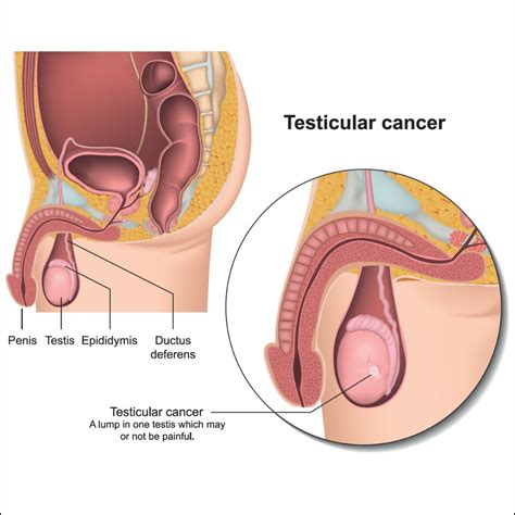 Testicular Lump Size