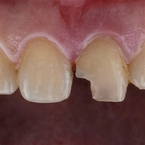 Invisible Front Teeth Filling | Dental Clinic Preston