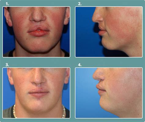 Bilateral Cleft Lip And Palate Before And After at Loretta Little blog