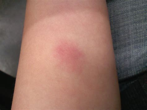 Negative tb test red but no bump - fetrmontreal