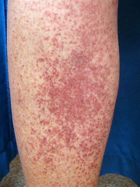 Leukemia Bruises: Pictures, Symptoms, Treatment