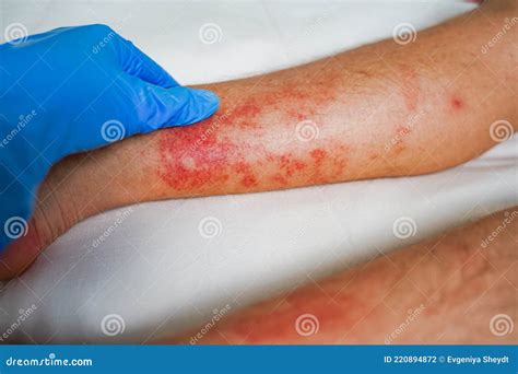 Eczema Skin Disease on the Legs, Itchy Red Rashes and Spots Stock Photo - Image of autoimmune ...