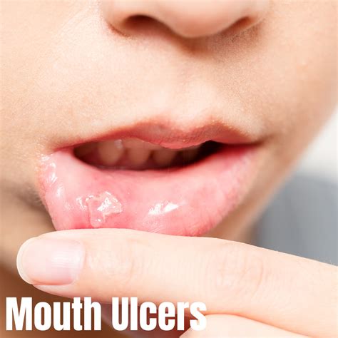 Mouth Ulcers - Aurum Dentistry