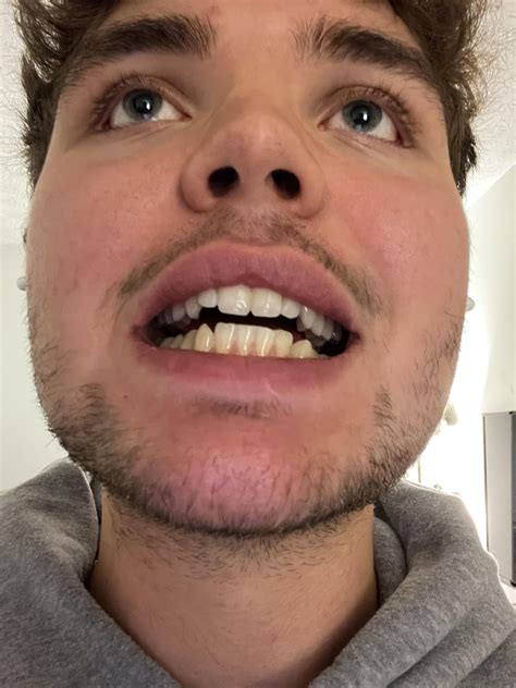 Earlier my friend mentioned that he messed up his jaw and his front teeth were no longer ...