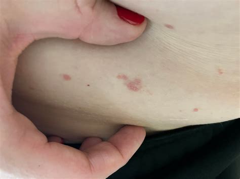 I would love some help. Rash that spread from torso onto back and arms over a period of two ...