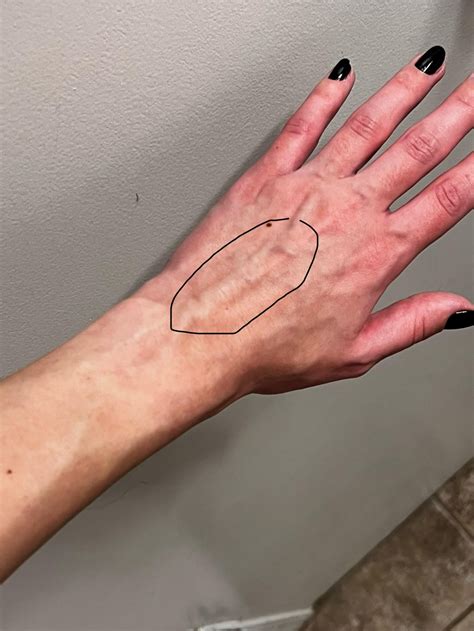 blood pooling : r/POTS