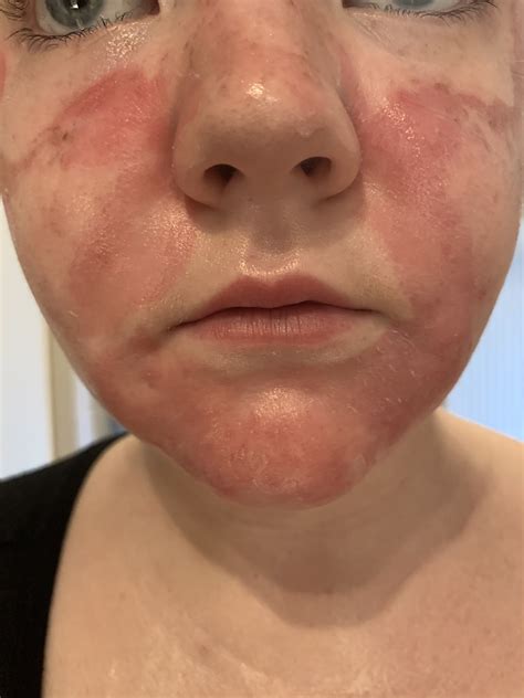 Chemical Burns On Face