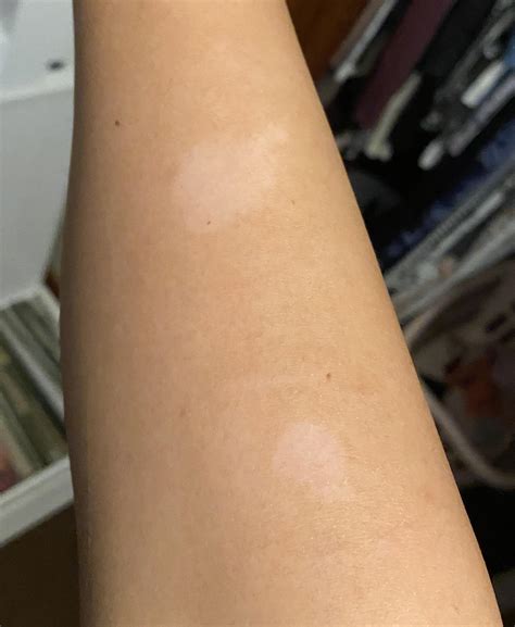 White patches appeared on my arm after poison ivy. Will it be a scar ...