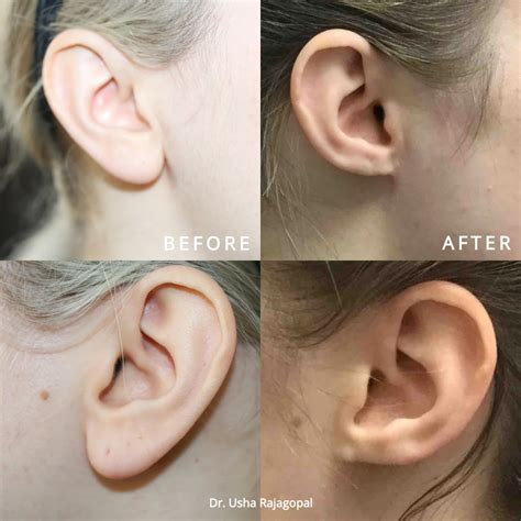 Ball In Earlobe After Wearing Earring at Erin Love blog