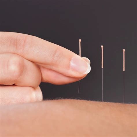 Acupuncture in Manhattan, NYC | Prestige Health and Wellness
