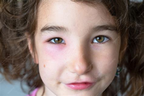 Premium Photo | A red swollen eyelid on a child face in closeup is an ...