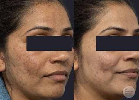#1 Best Post-Inflammatory Hyperpigmentation (PIH) Treatments
