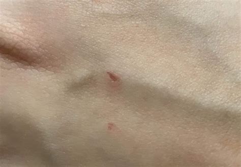 Bat Bite Images