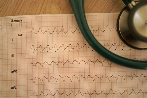 Wide Complex Tachycardia - The Cardiology Advisor