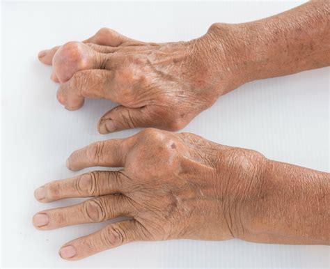 Can You Get Gout In Your Hand & Wrist? | Ladan Hajipour