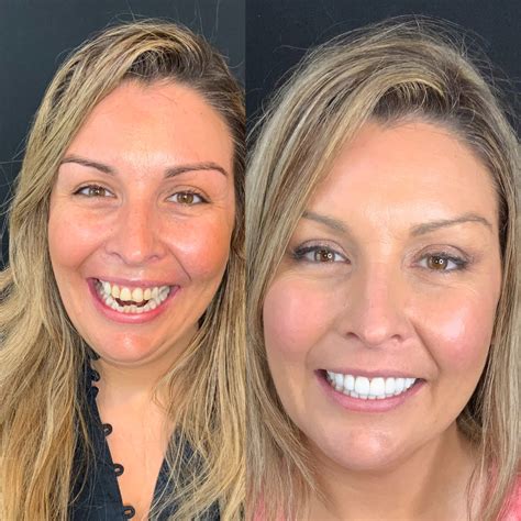 !Veneers Before And After: Transforming Your Smile! - Before After
