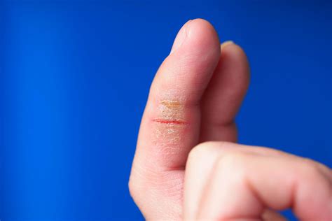 Understanding Hand and Wrist Dermatitis: Symptoms, Causes, and ...