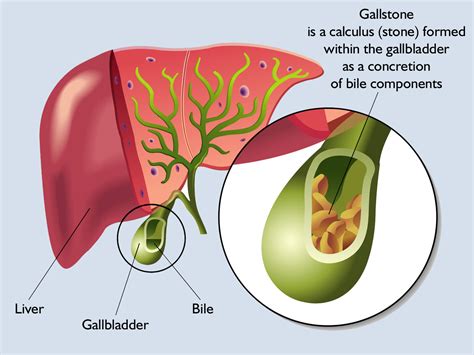 How do gallstones develop? - Mysurgeryabroad - Medicare Hospital Hungary