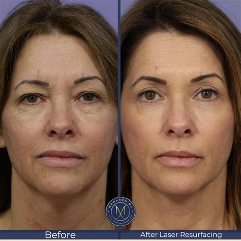 Fractional Laser Resurfacing