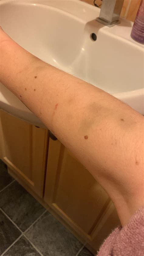 Is this normal bruising for someone with anemia? : r/Anemic