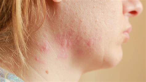Cystic Acne On Neck