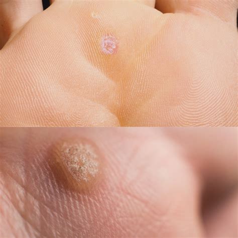 Difference Between Corn Callus And Verruca at Harry Carey blog