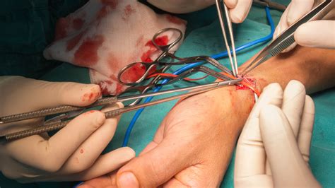 AV Fistula for Dialysis: Procedure, Care, and Risks Explained - Aetheris