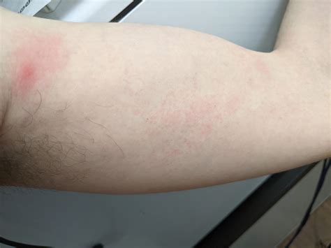 [33M] Painful pea-sized lump beneath skin in armpit, accompanied by a red bump with reddened ...