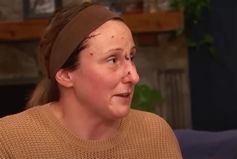 “I Think I Tried To Fight” Vermont Woman Describes Surviving Black Bear Attack