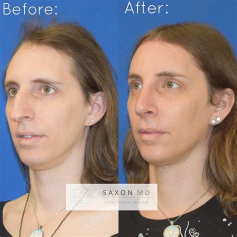 Best 12 Facial Feminization Surgery Before And After Photos – Artofit