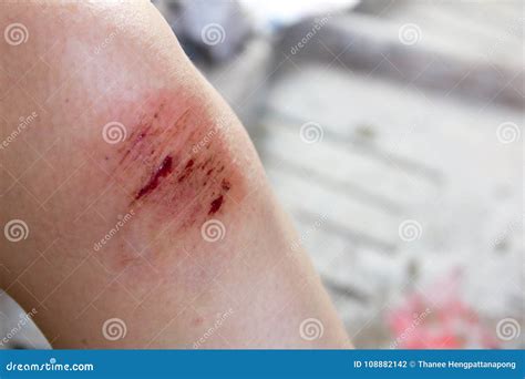 Bruised Wound Injury on Woman Knee Stock Photo - Image of contusion, health: 108882142