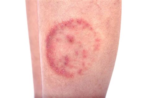 Differences Between Nummular Eczema vs. Ringworm