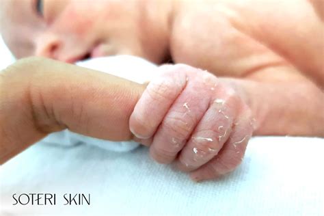 Newborn Dry Skin: Causes, Signs & Gentle Care Tips