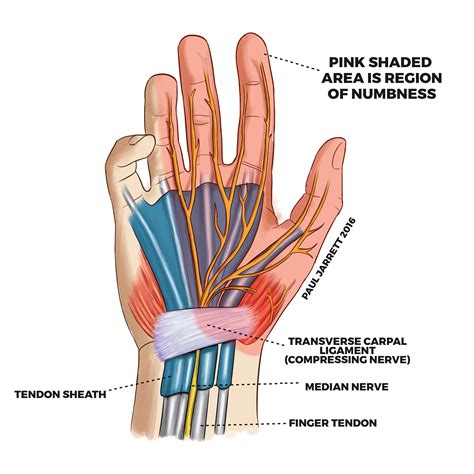 Carpal Tunnel Syndrome | Murdoch Orthopaedic Clinic