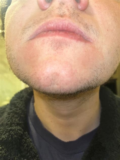 Rash under my mouth on my chin (Pictures in comments) : r/AskDocs