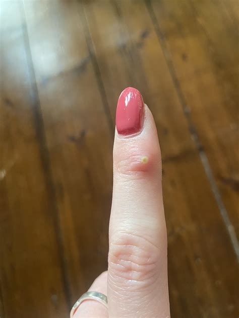 I have a painful finger pimple. Should I pop it? : r/PimplePoppersDelight