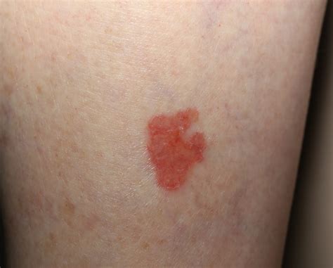 Advanced Basal Cell Carcinoma: Pictures, Symptoms, Treatment – WXSPZZ
