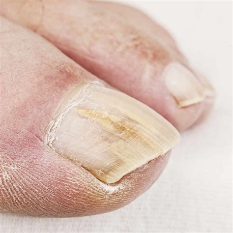 can vinegar kill toenail fungus - Toenail Fungus Treatment | Toenail Fungus Treatment
