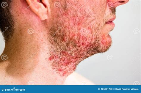 Seborrheic Dermatitis Beard