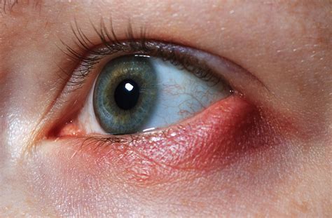 Stye: Causes, Symptoms, Treatment & Preventive Measures