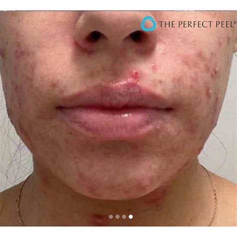 Chemical Peel Before and After for Acne | Prfkt® Pro