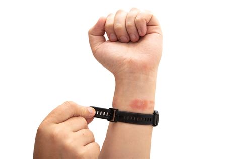 Is Eczema Contagious? Myths, Truths & Advice