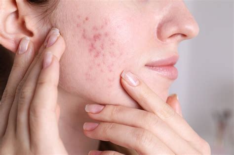 What drives acne relapse? New study explores isotretinoin outcomes