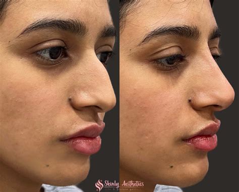 Non-Surgical Rhinoplasty - Before and After Results