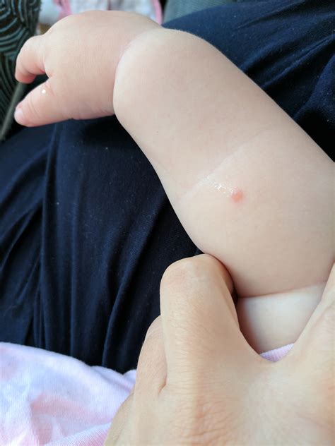 Pimple On Thigh